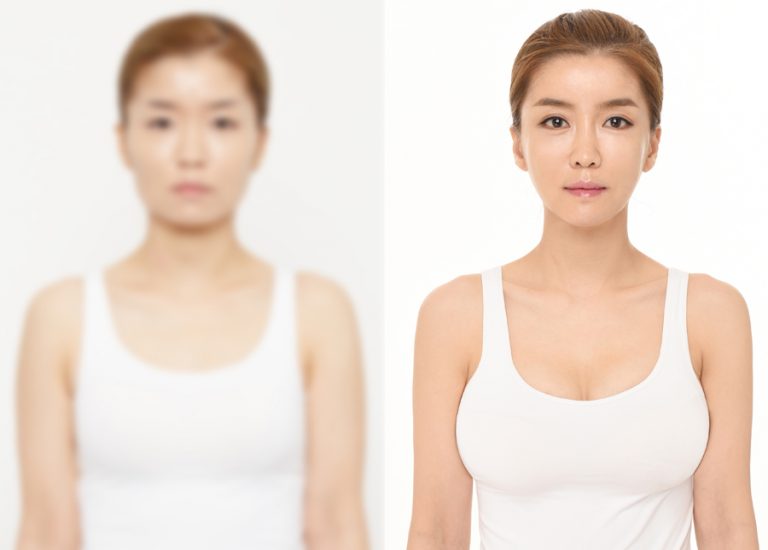 before_after_breast3