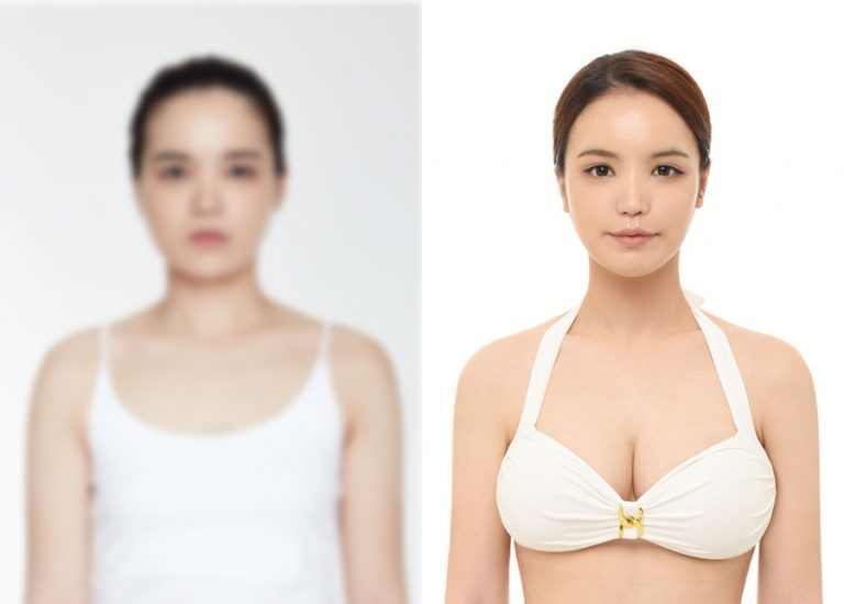 before_after_breast1