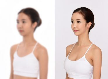 before_after_breast4