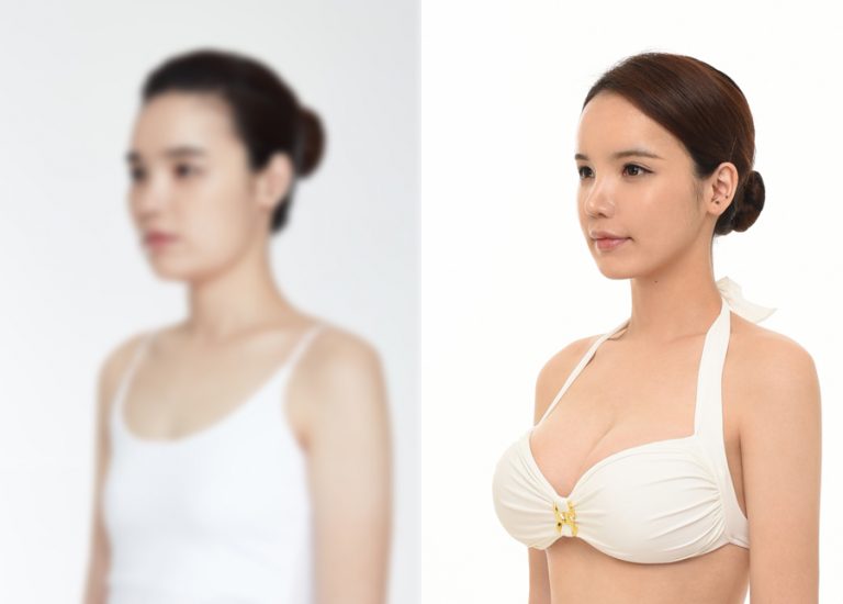 before_after_breast5