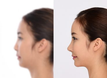 before_after_nose1