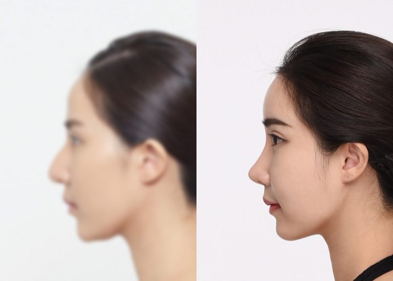 before_after_nose2