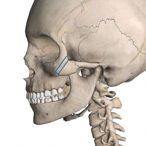 3D CT 頬骨縮小術1
