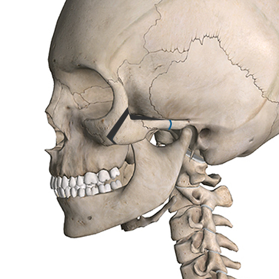 3D CT 頬骨縮小術2