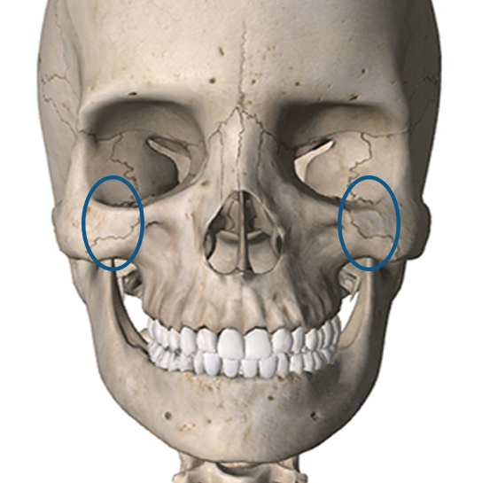 3D CT 頬骨縮小術5