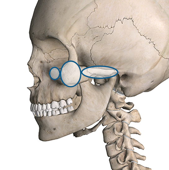 3D CT 頬骨縮小術7