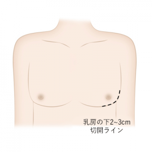女性化乳房2