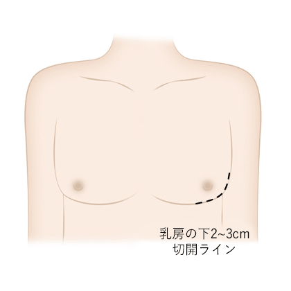 女性化乳房2