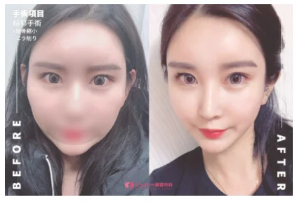 韓国顔面輪郭手術