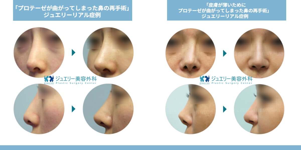 韓国鼻の再手術