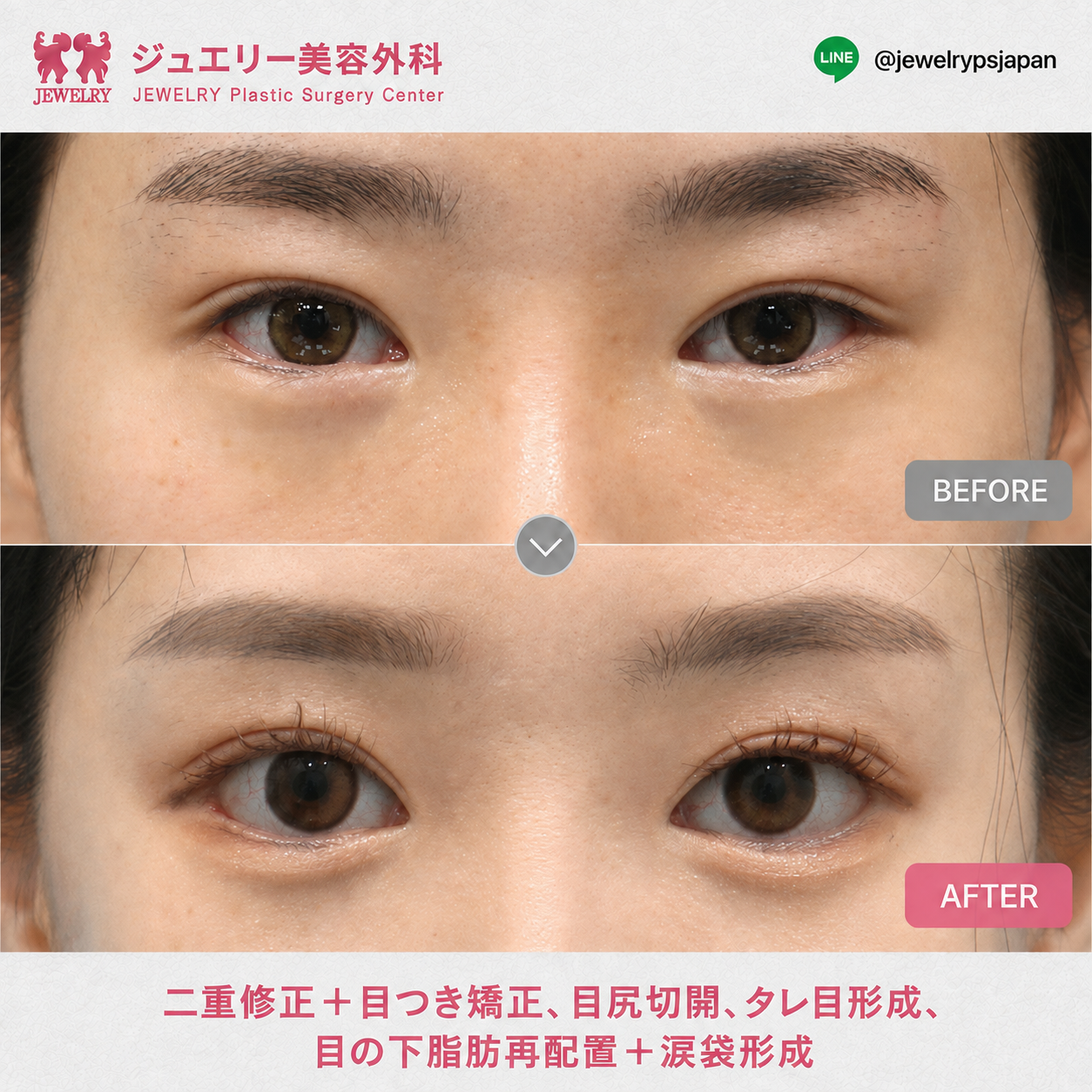 二重修正・眼瞼下垂矯正・目尻切開・タレ目形成・目の下の脂肪再配置・涙袋形成の目元症例その1