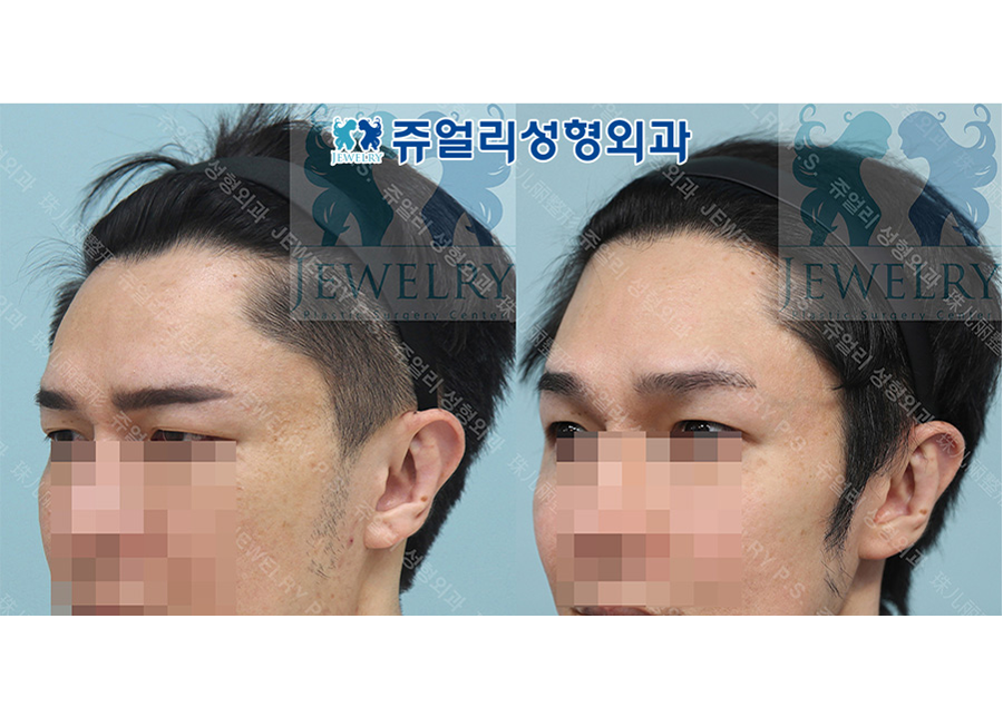 アンチエイジング・リフトの術前・術後写真 2