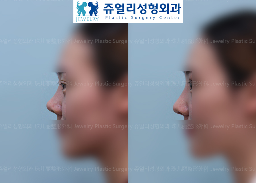 鼻の整形の術前・術後写真 3
