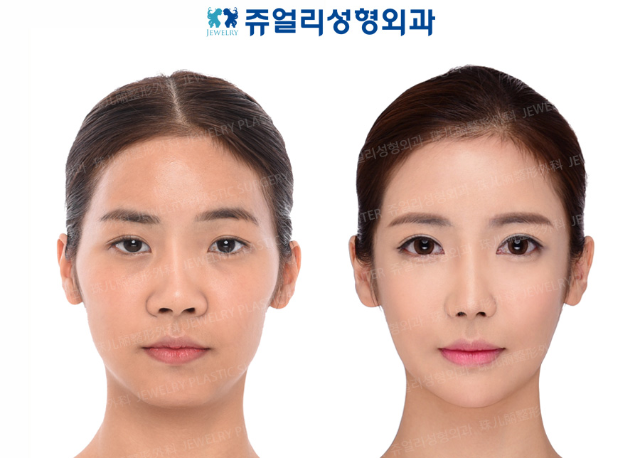 その他の術前・術後写真 1