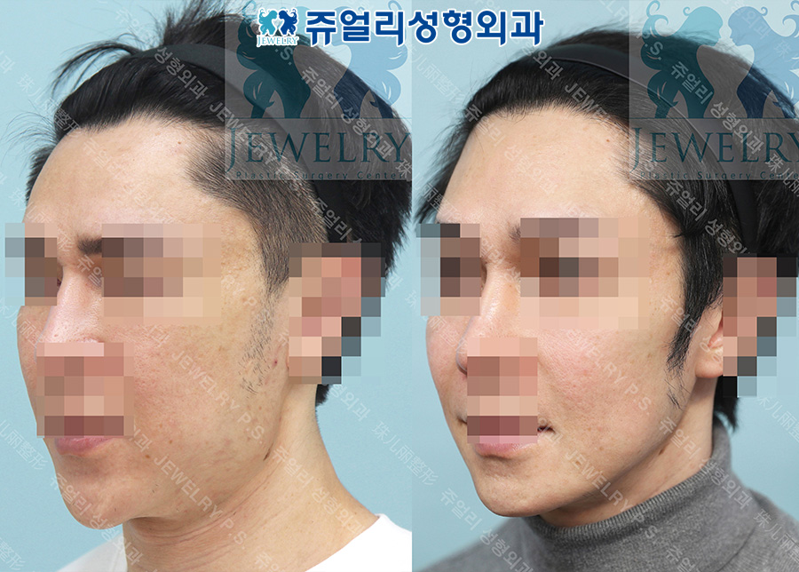 輪郭整形の術前・術後写真 2
