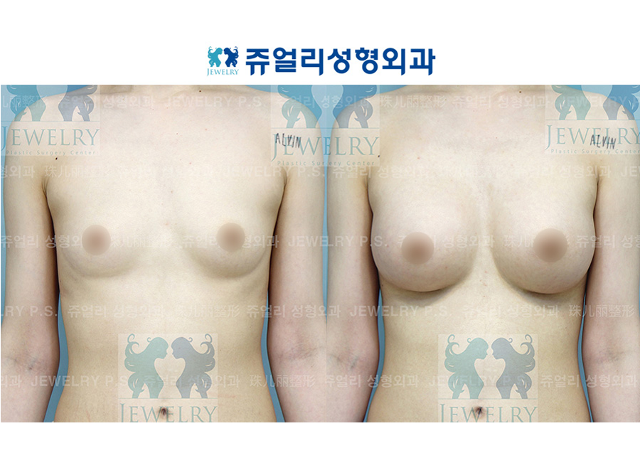 豊胸の術前・術後写真 1