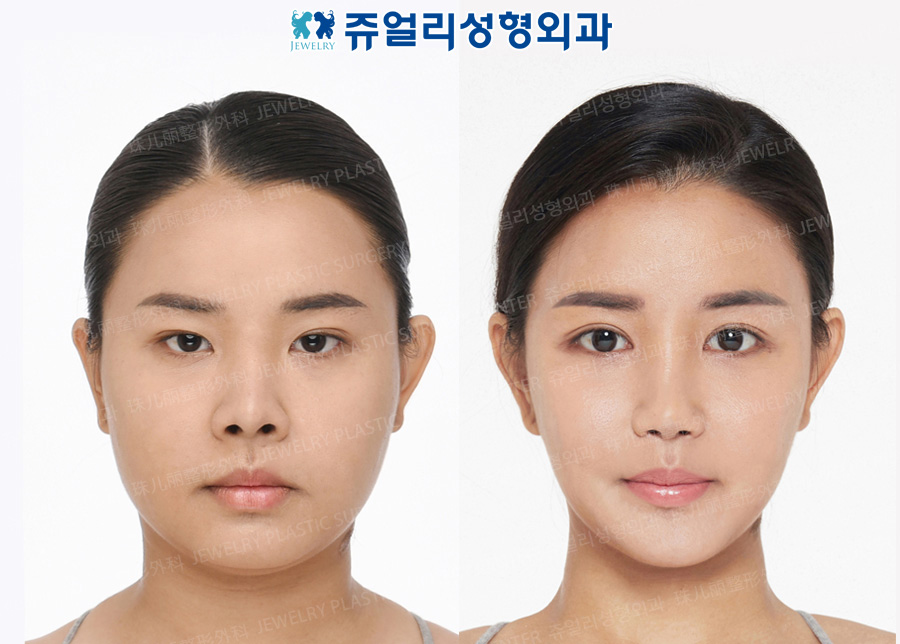 その他の術前・術後写真 1