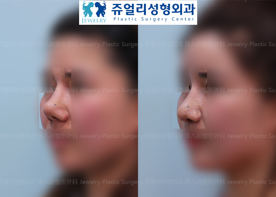 鼻の整形の術前・術後写真 2