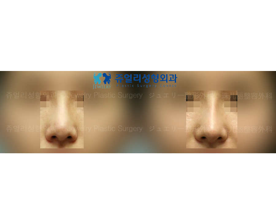 鼻の整形の術前・術後写真 1