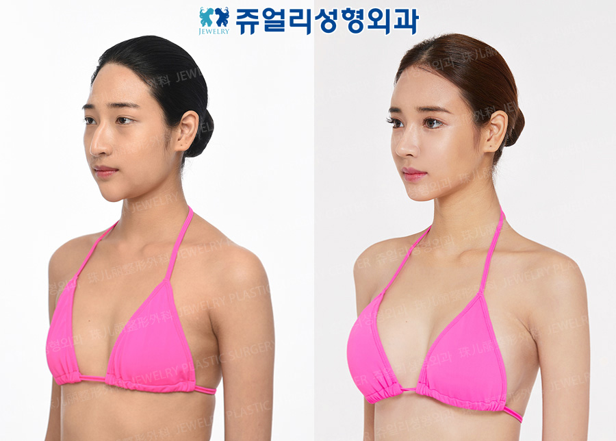 豊胸の術前・術後写真 2