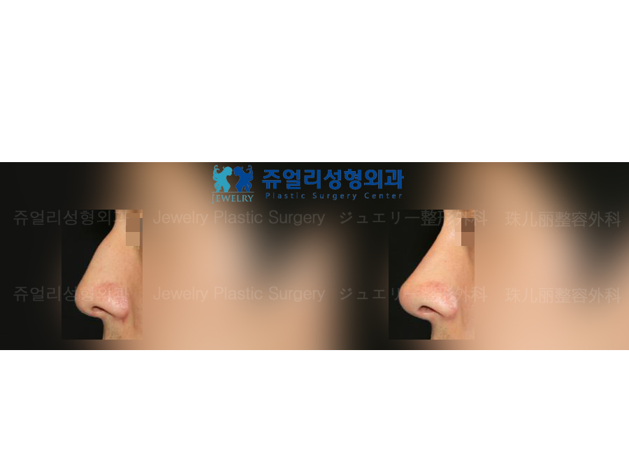鼻の整形の術前・術後写真