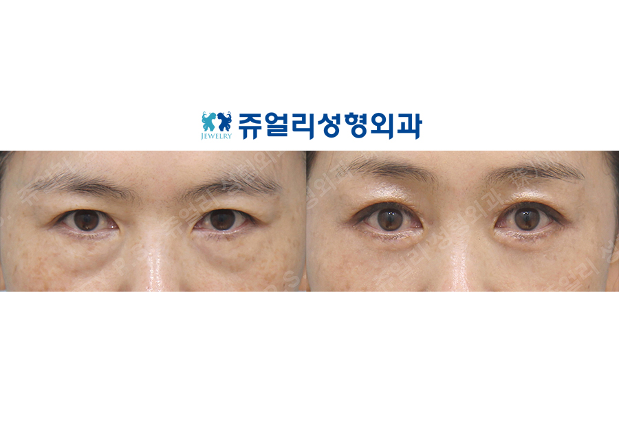 目の整形の術前・術後写真