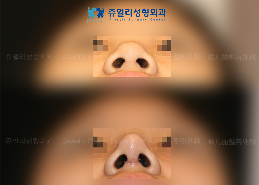 鼻の整形の術前・術後写真