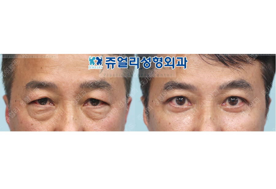 目の整形の術前・術後写真