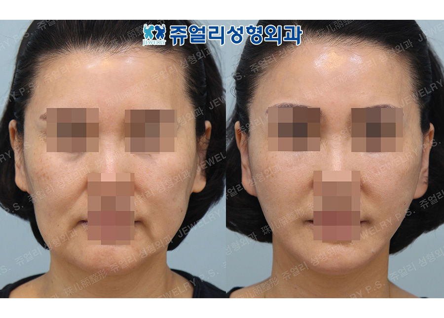 アンチエイジング・リフトの術前・術後写真 1