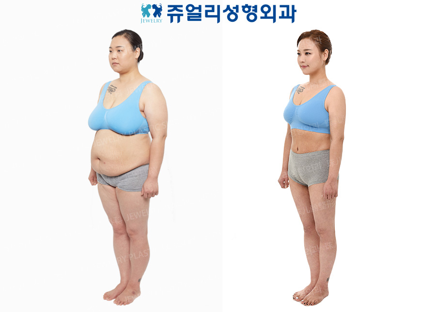 ボディ整形の術前・術後写真 3