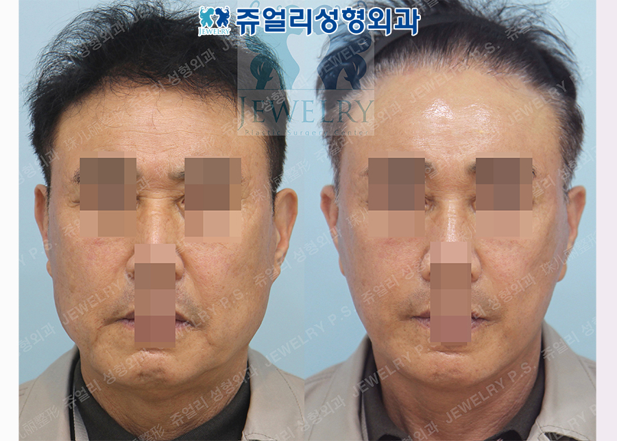 アンチエイジング・リフトの術前・術後写真 1