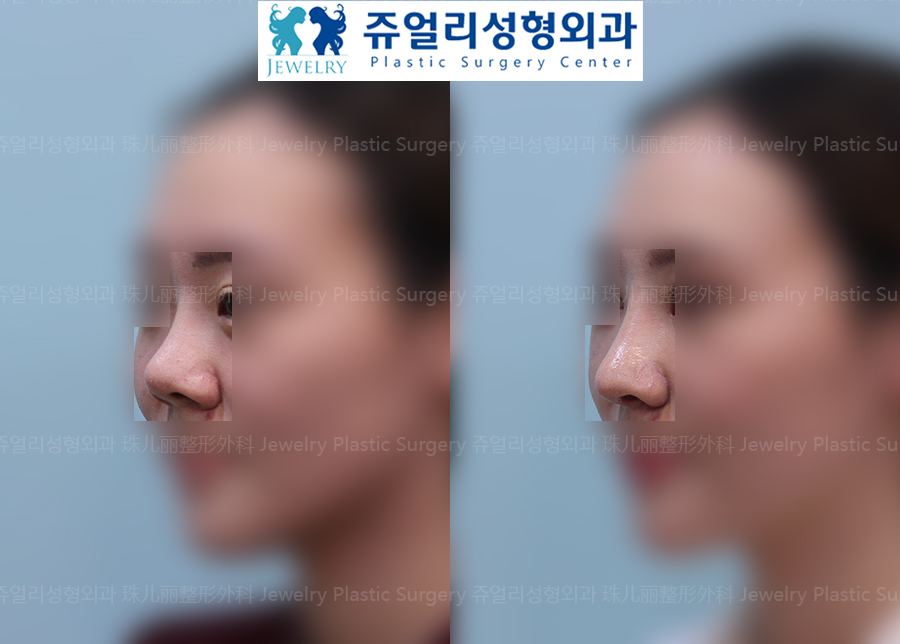 鼻の整形の術前・術後写真 2