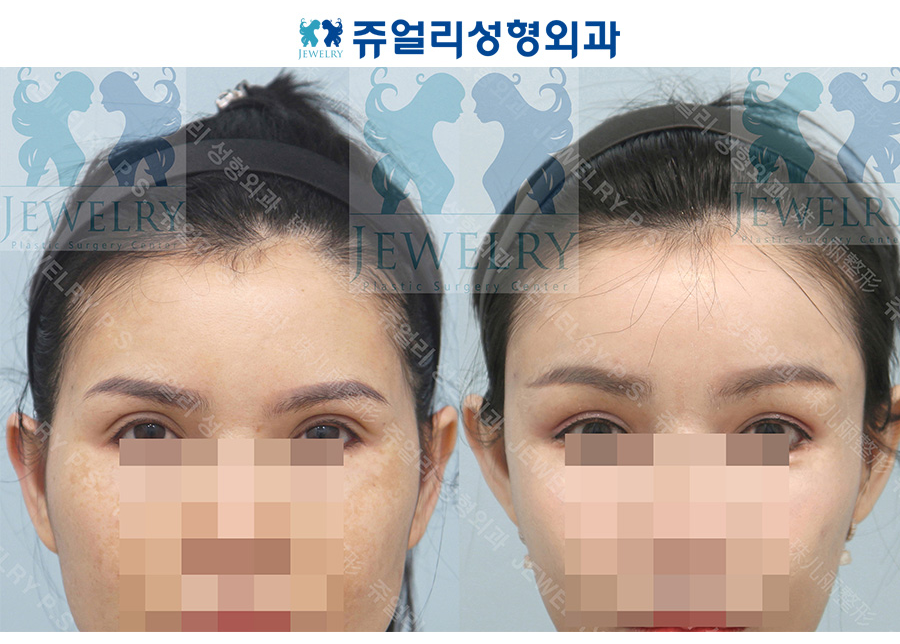 アンチエイジング・リフトの術前・術後写真