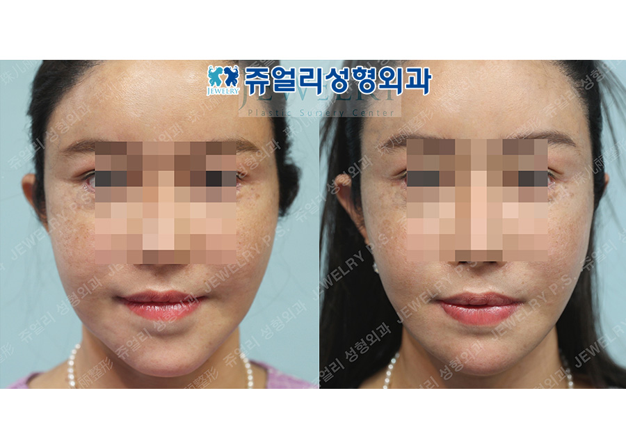 アンチエイジング・リフトの術前・術後写真