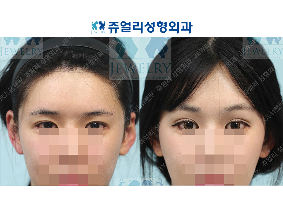 アンチエイジング・リフトの術前・術後写真 1