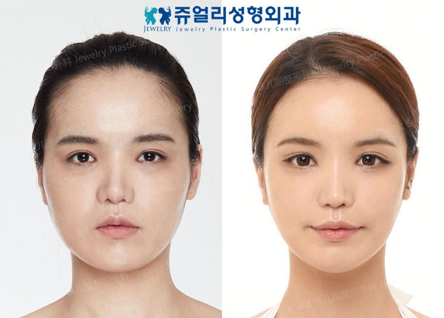 その他の術前・術後写真 1