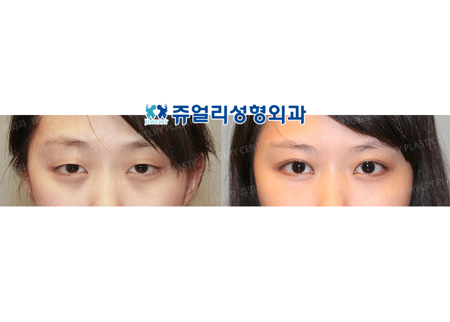 目の整形の術前・術後写真