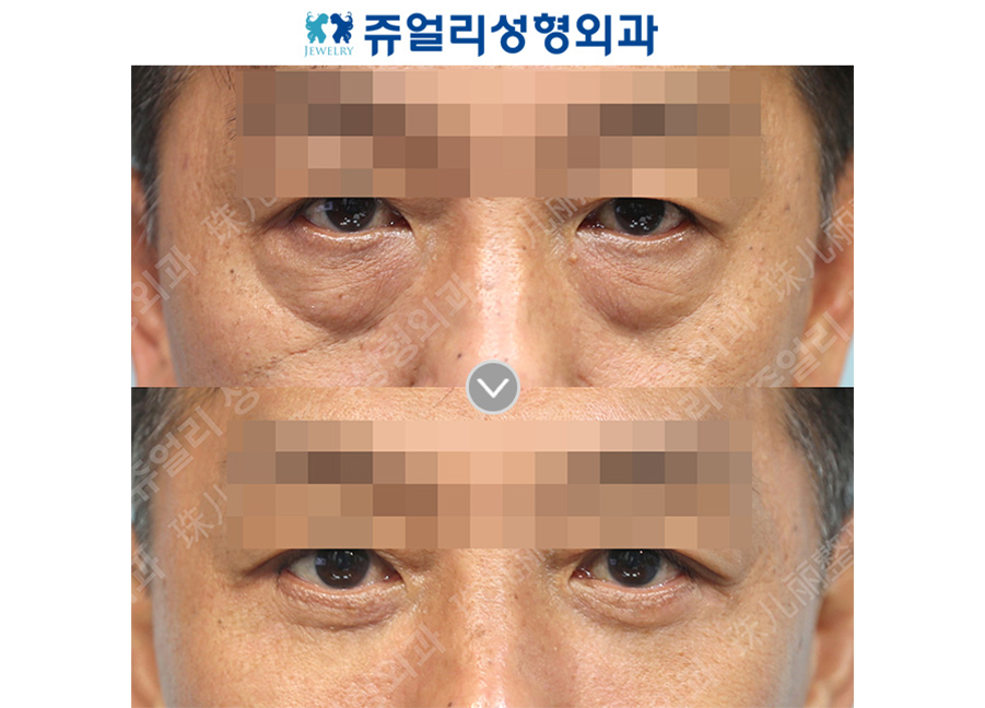 目の整形の術前・術後写真