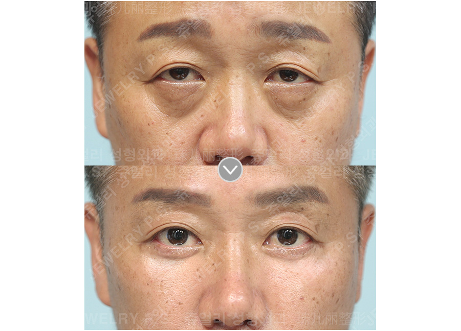目の整形の術前・術後写真