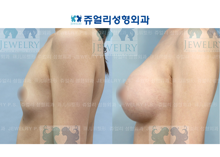 豊胸の術前・術後写真 3