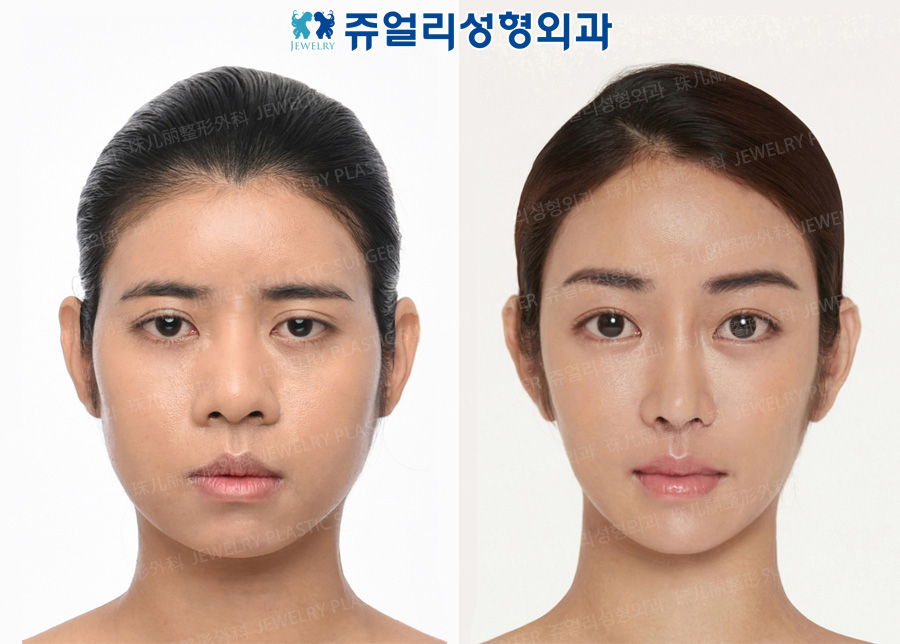 その他の術前・術後写真 1