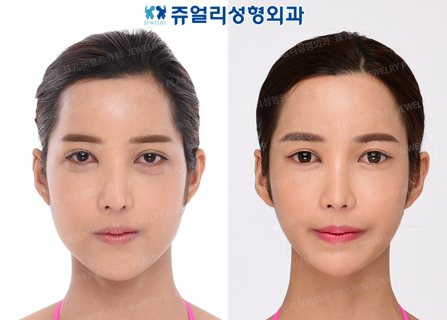 その他の術前・術後写真 1