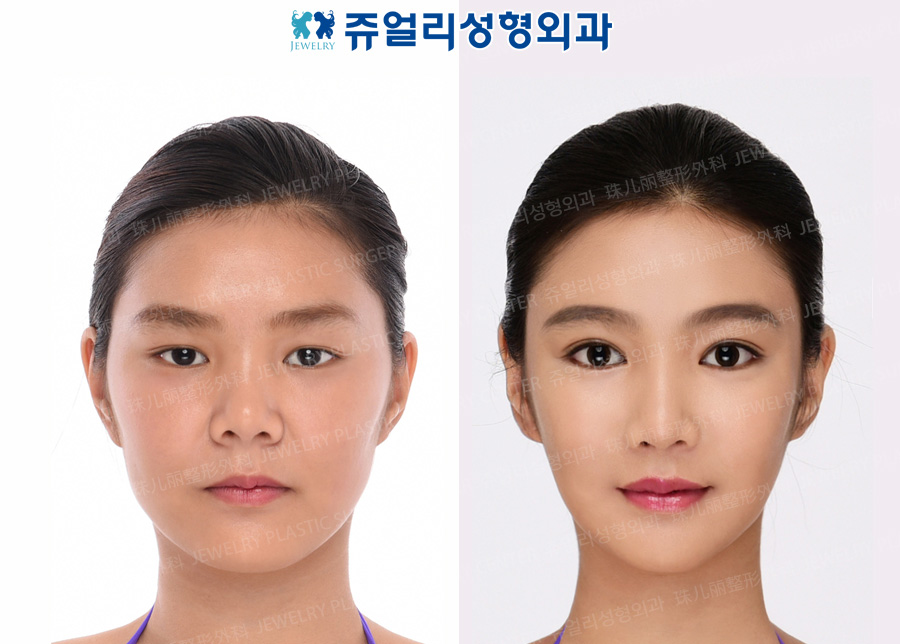 その他の術前・術後写真 1