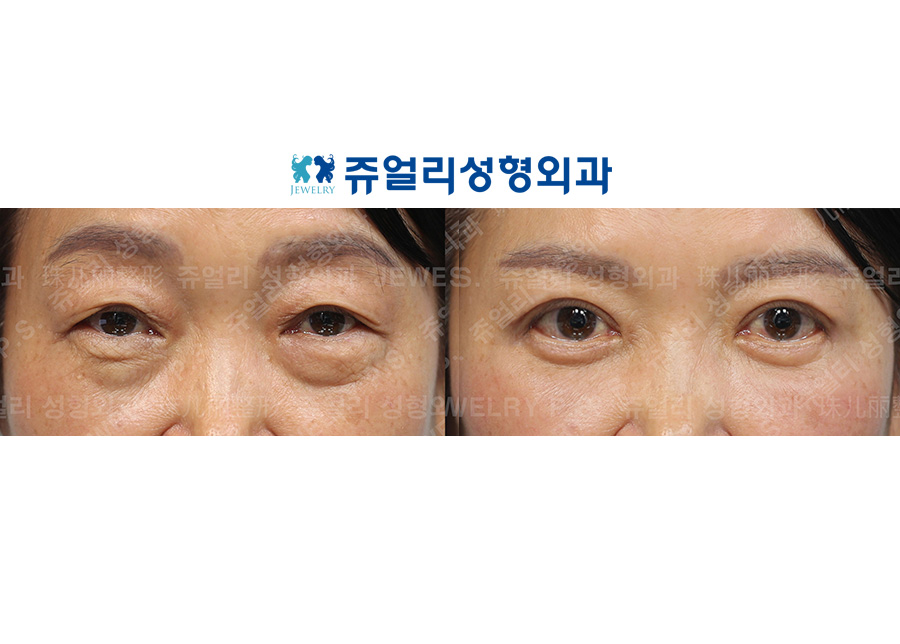 目の整形の術前・術後写真