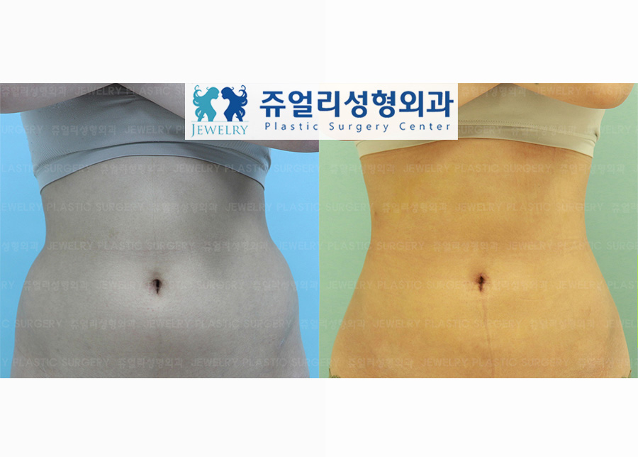 ボディ整形の術前・術後写真 1