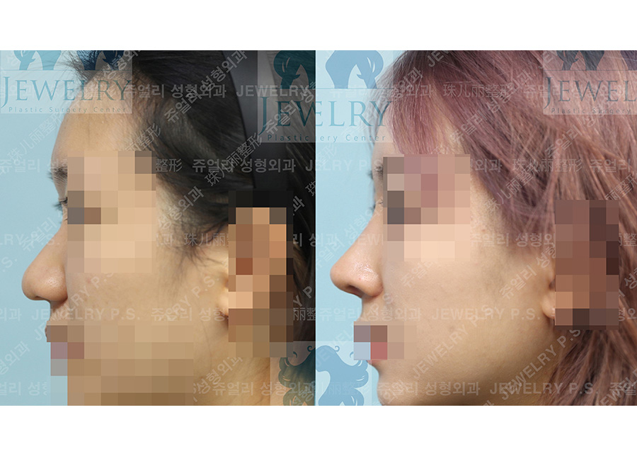 鼻の整形の術前・術後写真 3