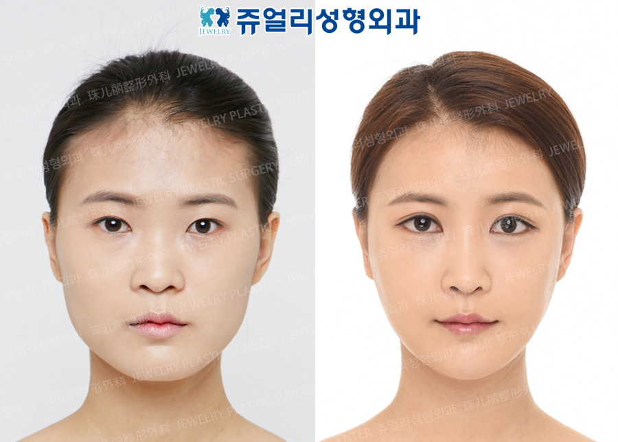 その他の術前・術後写真 1