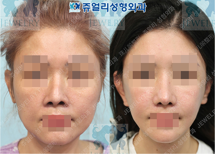 アンチエイジング・リフトの術前・術後写真 1