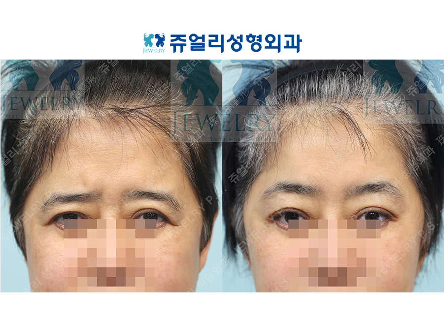 アンチエイジング・リフトの術前・術後写真
