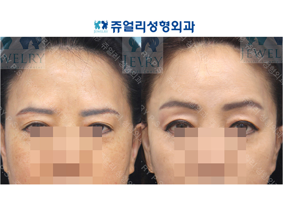 アンチエイジング・リフトの術前・術後写真